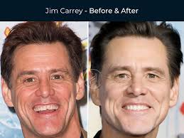 Permanent Dentures Celebrity Dental Implants Before And After