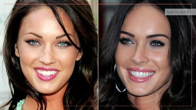 Permanent Dentures Celebrity Dental Implants Before And After