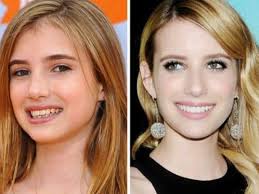 Permanent Dentures Celebrity Dental Implants Before And After