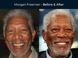 Permanent Dentures Celebrity Dental Implants Before And After