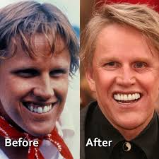 Permanent Dentures Celebrity Dental Implants Before And After