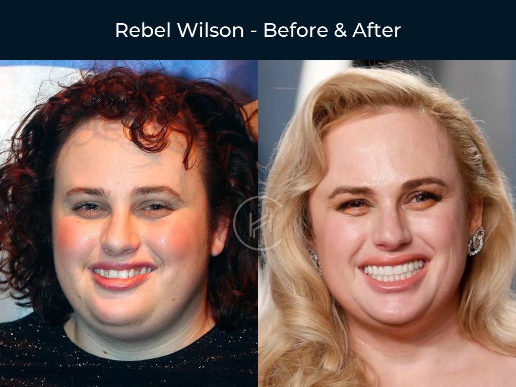 Permanent Dentures Celebrity Dental Implants Before And After