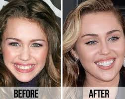 Permanent Dentures Celebrity Dental Implants Before And After