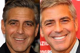 Permanent Dentures Celebrity Dental Implants Before And After