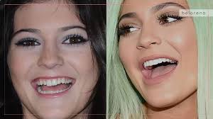 Permanent Dentures Celebrity Dental Implants Before And After