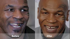 Permanent Dentures Celebrity Dental Implants Before And After