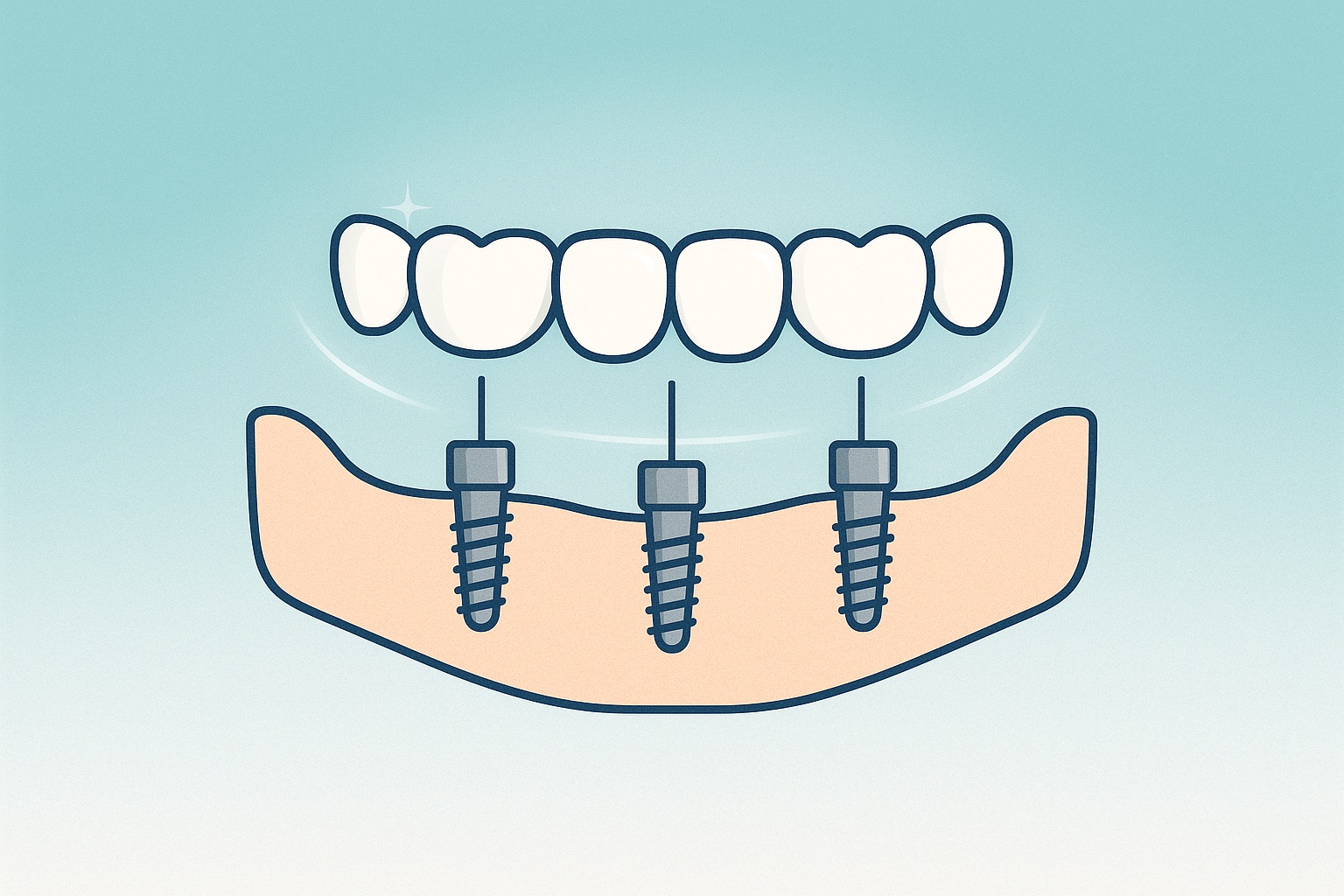 What Are The Problems With All-On-4 Dental Implants