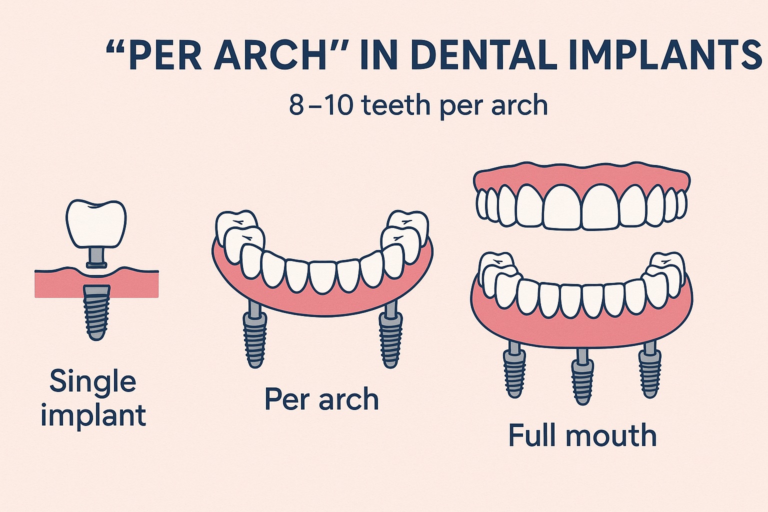 What Does Per Arch Mean In Dental Implants