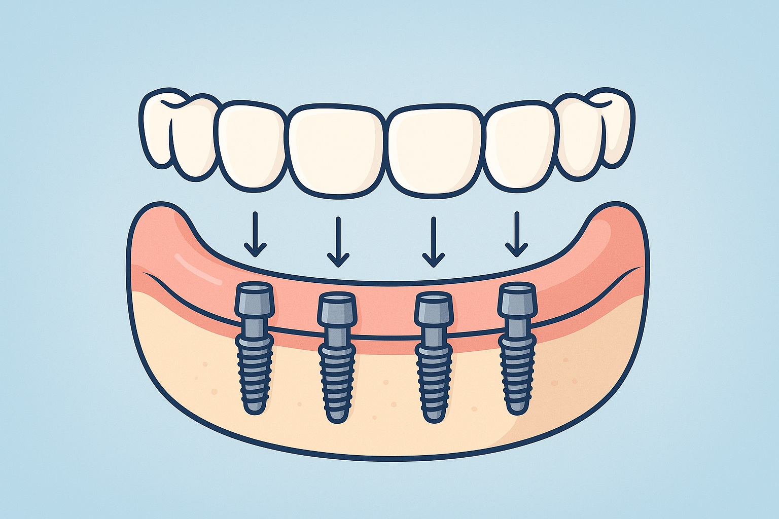 What Is Considered An Arch In Dental Implants