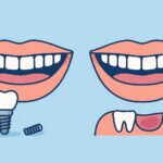 Dental Implant Pain Years Later