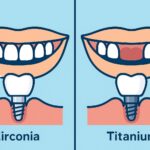 Dental Implants Zirconia Vs Titanium