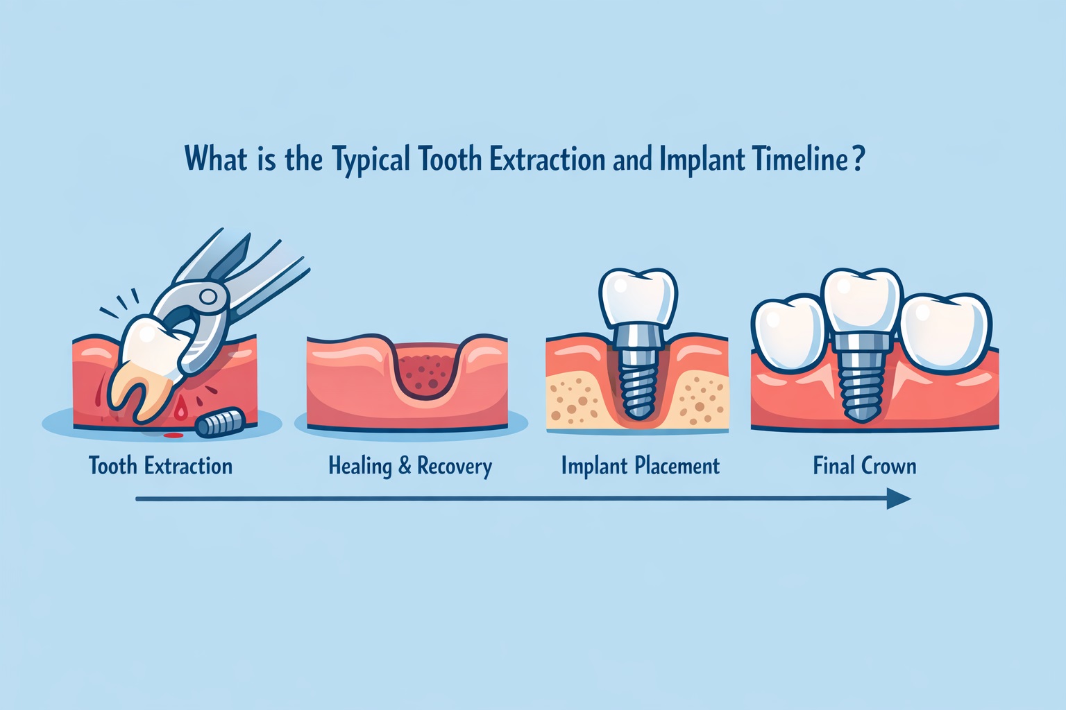 What is the Typical Tooth Extraction and Implant Timeline