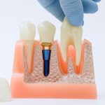 What Are the Side Effects of Dental Implant Removal?
