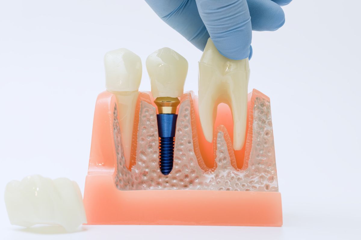 What Are the Side Effects of Dental Implant Removal