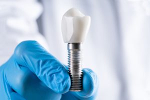 What Should You Know About Dental Implants Annandale